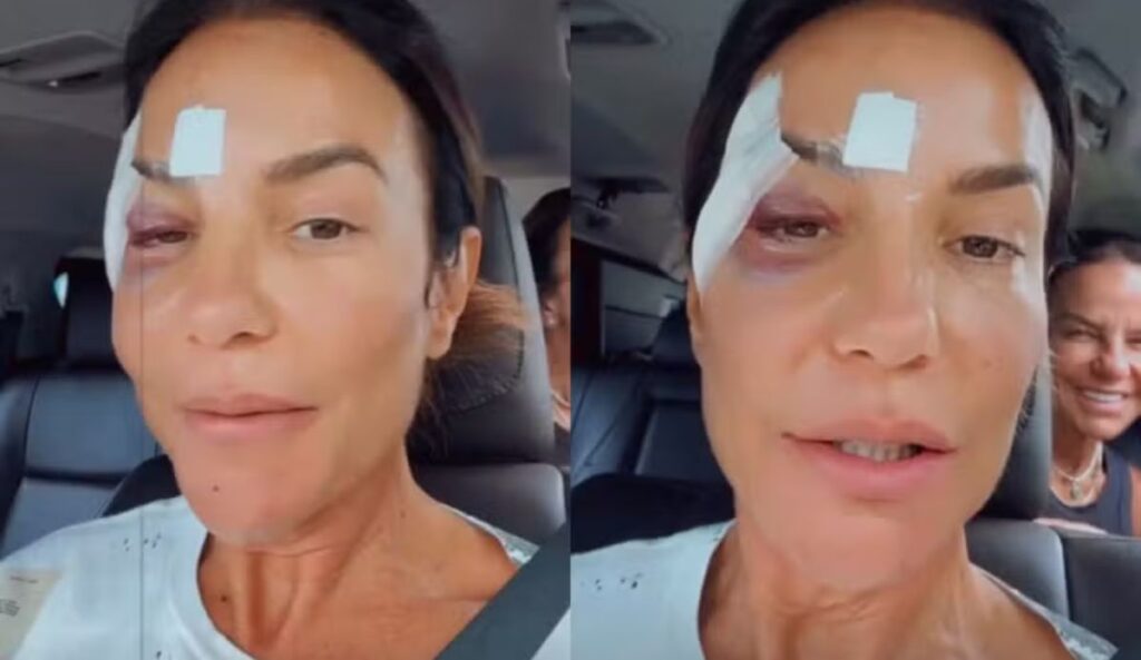 Ivete Sangalo mostra hematoma no olho esquerdo e curativo na testa após desmaio provocado por desidratação e reflexo vagal, em vídeo publicado nas redes sociais.